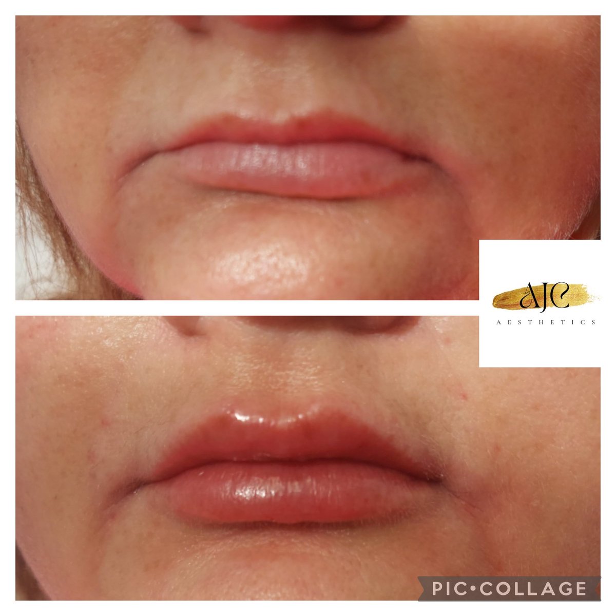 AliC1605's tweet photo. Just look at this stunning lip enhancement, unevened lips corrected to look plump and natural 💋 https://t.co/Mw7EvfHizr