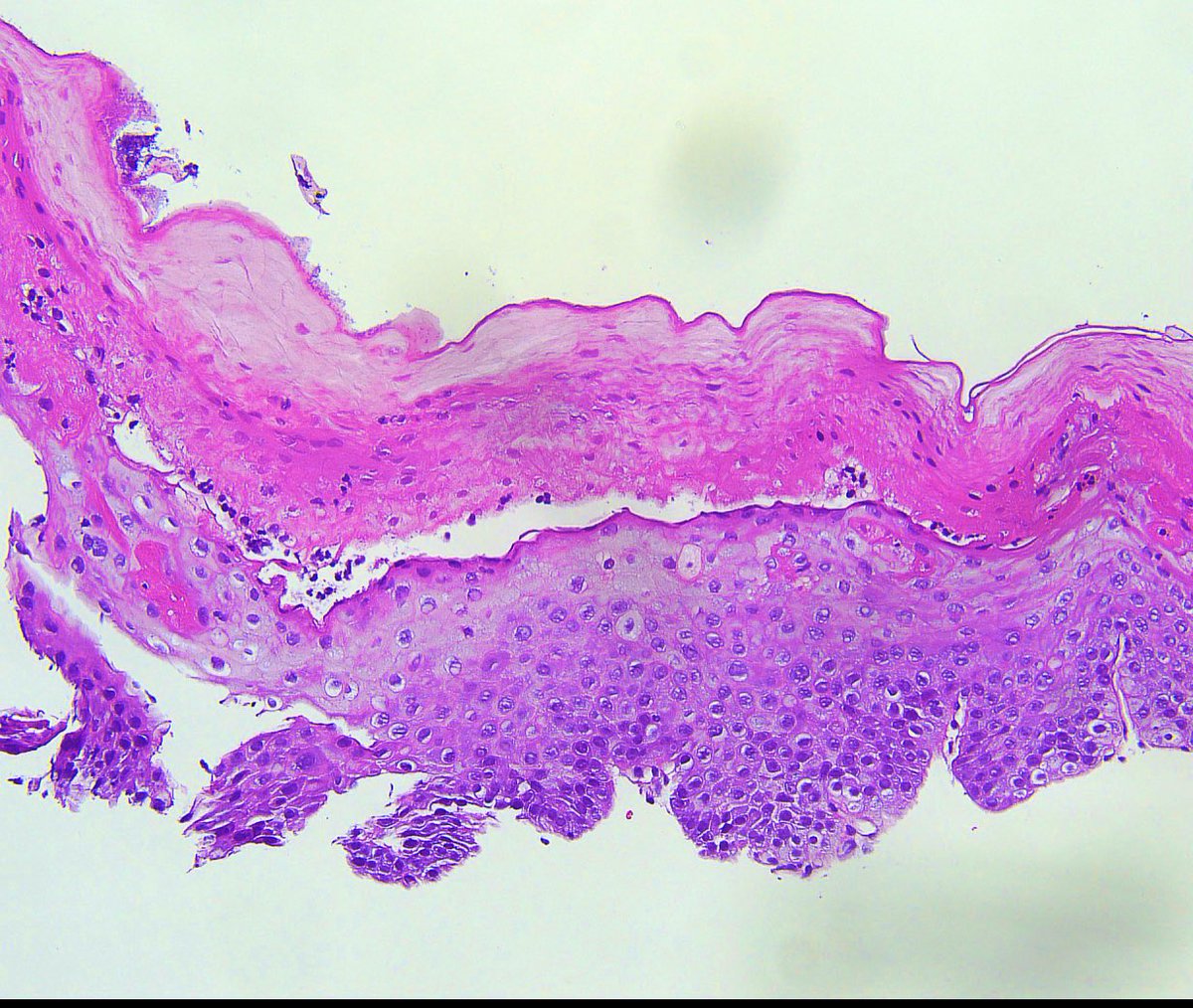 rhpath65's tweet photo. 72-year-old male with iron deficiency anemia .  
Distal esophagus biopsy: 
Esophagitis dissecans superficialis.
#medtwitter #PathTwitter #pathology #Path #path2path #pathoutpic #GIpath https://t.co/rNvVlZIKFM