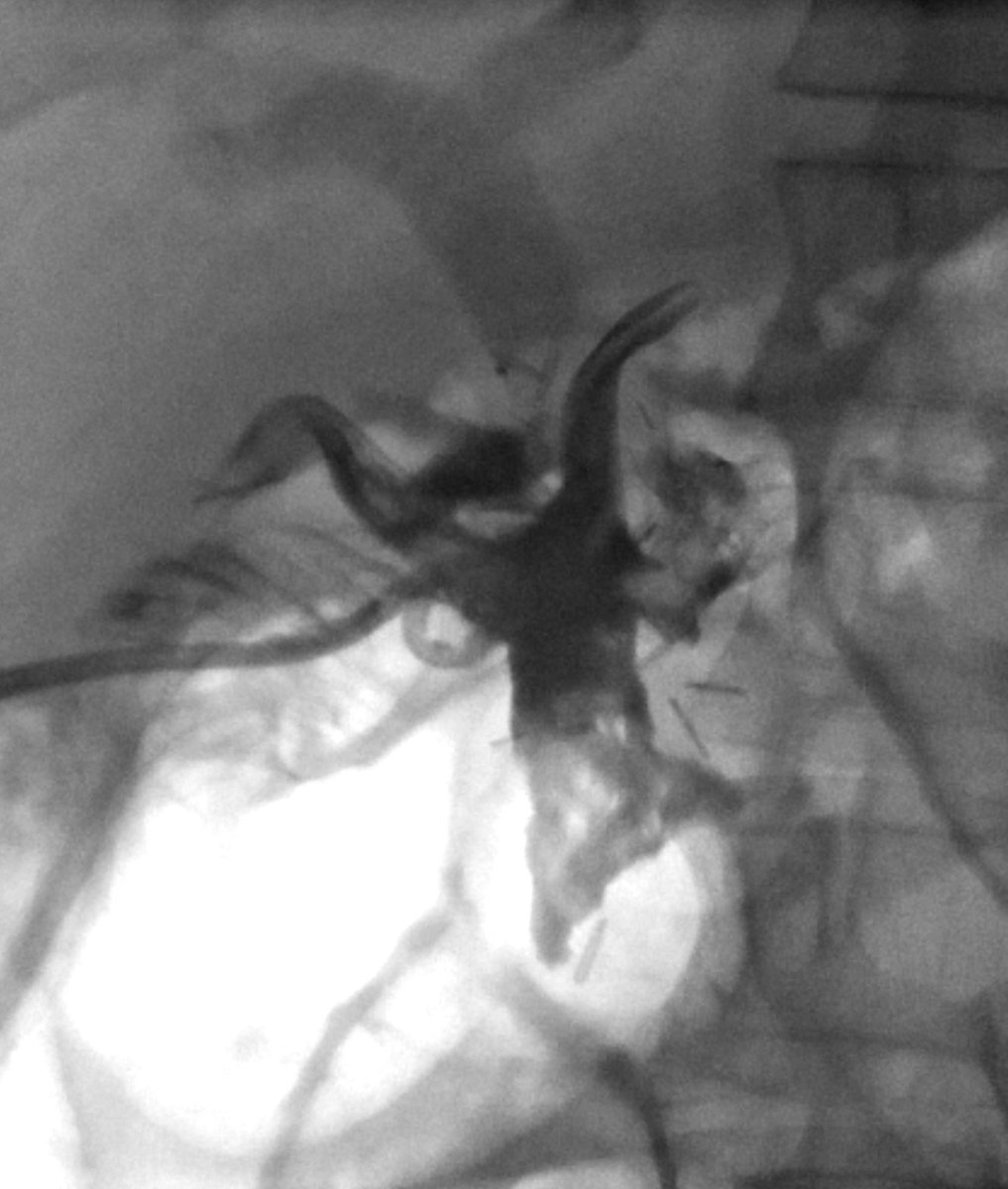 michaeldburns's tweet photo. @CAIRweb Drain putting out bile and blood x 5 days. We did a “tubogram”. Contrast fills small bowel -> leak at choledochojejunostomy. Contrast also fills SMV then portal vein -> residual SMV venotomy from surgery. Infected bile entering vein causing bacteremia = cause of rigors. 2/2 https://t.co/oTsWrp1Npv