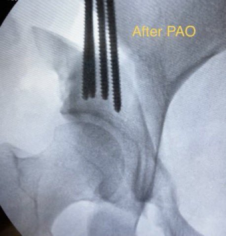 DrDerekOchiai's tweet image. If you're told you have #HipDysplasia with NO arthritis and the surgeon does not even mention "PAO", you should get a second opinion. Periacetabular osteotomy is a powerful operation to correct severe dysplasia. Mild dysplasia can be treated with #HipArthroscopy.