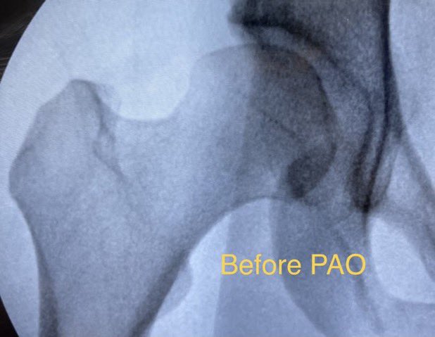 DrDerekOchiai's tweet image. If you're told you have #HipDysplasia with NO arthritis and the surgeon does not even mention "PAO", you should get a second opinion. Periacetabular osteotomy is a powerful operation to correct severe dysplasia. Mild dysplasia can be treated with #HipArthroscopy.