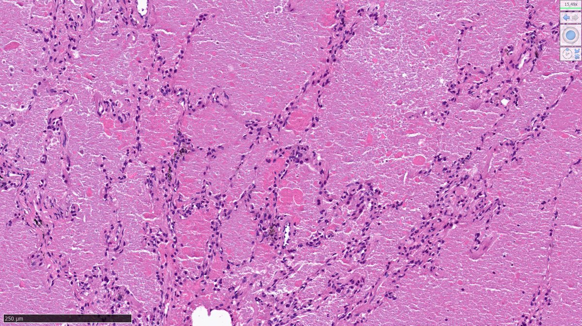 42M smoker, SOB and cough. What is your diagnosis? #PathTwitter #pulmpath #thoracicpathology #Pulmtwitter #pathology #histopathology #surgicalpathology