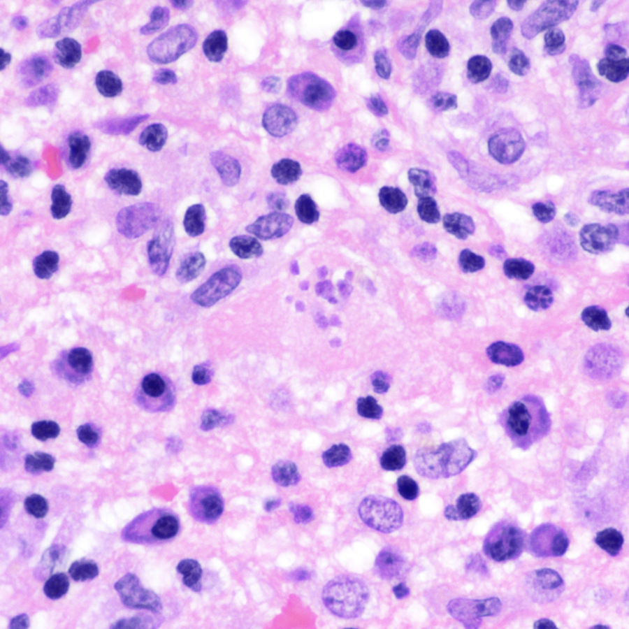 CraigHorbinski's tweet photo. Brain lesion in an immunocompromised patient. What's the immunostain in the second image? (Hint:😼) #pathology #neuropath #PathTwitter #infectiousdisease https://t.co/xcCXRfskED