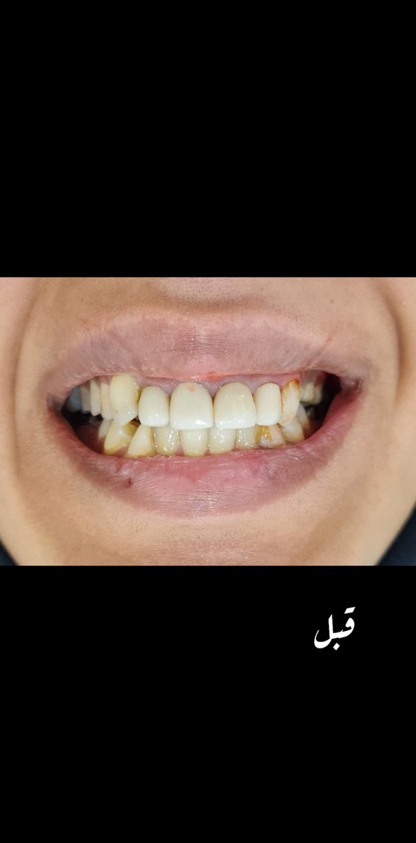 FatmaSuliman14's tweet photo. الحالة قبل قص اللثه وقبل التجميل

Add me on Snapchat! Username: drfatmasulimanc https://t.co/MJ7f174Jdq https://t.co/mXOkSSD9cB