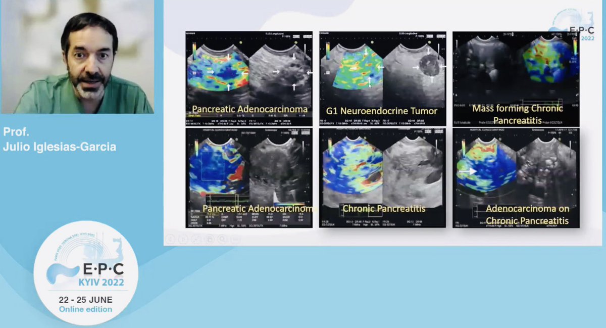 helpatologist's tweet photo. @JulioIglGar reassuring us on the role of EUS elasto in Panc ♋️ 

Let’s see if has managed to convert a few of our 🇺🇸 friends ⁉️😊@BilalMohammadMD @ASGEendoscopy @EndoTx @DrHasan_Orlando @TarunRustaGI_MD @SunilAminMD @drdalbir @drsethinyc @DrSaeeeed @neilRsharmaMD 

#EPCKyiv2022 https://t.co/eWpkRT794Y