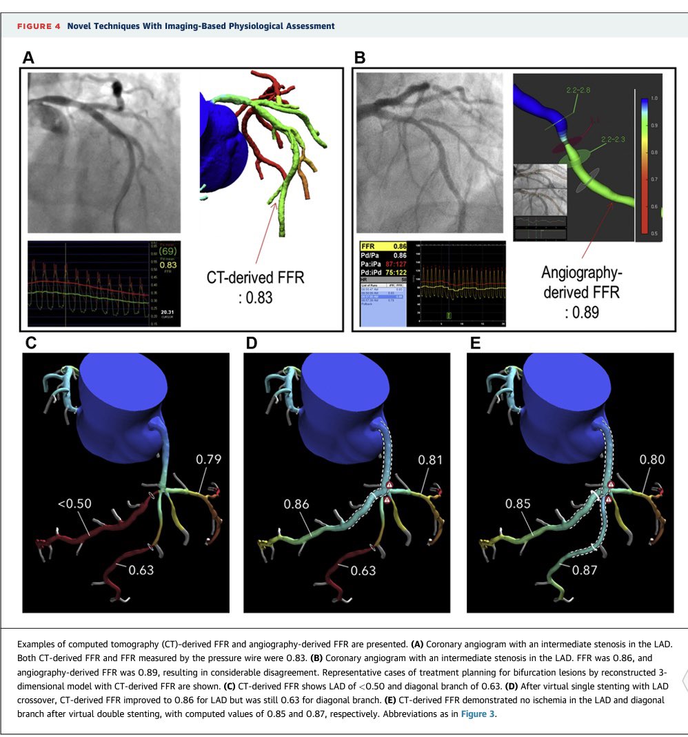 Manuel Pan (@mpaoss) on Twitter photo Consensus about physiology in bifurcation lesions. Experts from Korea, Japan and EBC. <a href="/GoranEBC/">Goran Stankovic, MD, PhD</a> <a href="/BURZOTTA_F/">FRANCESCO BURZOTTA</a> <a href="/LAzzaliniMD/">Lorenzo Azzalini</a> <a href="/BifurcationClub/">European Bifurcation Club</a> <a href="/PCRonline/">PCRonline 🫀</a> <a href="/TCTMD/">TCTMD</a> <a href="/shci_sec/">ACI-SEC: Hemodinamica</a> <a href="/belcid7/">Belén Cid Alvarez</a> <a href="/oriolrodriguez5/">Oriol Rodriguez</a> <a href="/secardiologia/">Soc Esp Cardiología</a> <a href="/ignamatsant/">Ignacio J. Amat</a> <a href="/RodrigoEstvez1/">Rodrigo Estévez</a> <a href="/rafaelglezm/">Rafael Gonzalez-Manzanares</a> <a href="/evandrofilhobr/">Evandro Martins F. MD</a> <a href="/MesaLola/">Lola mesa rubio</a> Consensus about physiology in bifurcation lesions. Experts from Korea, Japan and EBC. <a href="/GoranEBC/">Goran Stankovic, MD, PhD</a> <a href="/BURZOTTA_F/">FRANCESCO BURZOTTA</a> <a href="/LAzzaliniMD/">Lorenzo Azzalini</a> <a href="/BifurcationClub/">European Bifurcation Club</a> <a href="/PCRonline/">PCRonline 🫀</a> <a href="/TCTMD/">TCTMD</a> <a href="/shci_sec/">ACI-SEC: Hemodinamica</a> <a href="/belcid7/">Belén Cid Alvarez</a> <a href="/oriolrodriguez5/">Oriol Rodriguez</a> <a href="/secardiologia/">Soc Esp Cardiología</a> <a href="/ignamatsant/">Ignacio J. Amat</a> <a href="/RodrigoEstvez1/">Rodrigo Estévez</a> <a href="/rafaelglezm/">Rafael Gonzalez-Manzanares</a> <a href="/evandrofilhobr/">Evandro Martins F. MD</a> <a href="/MesaLola/">Lola mesa rubio</a>