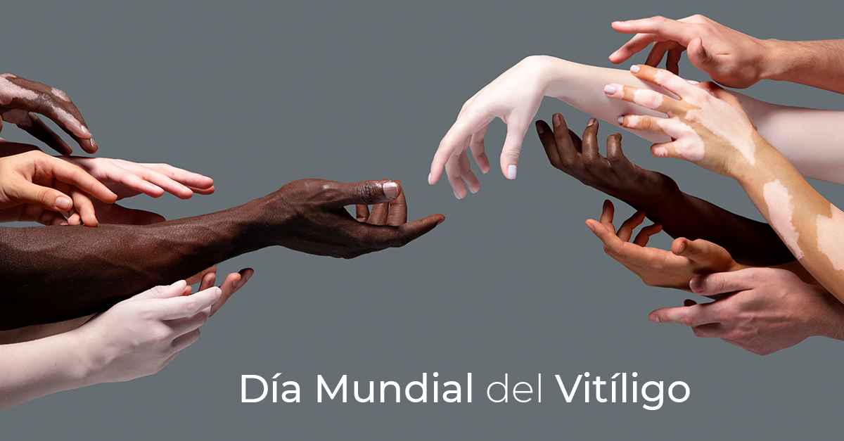 El #vitíligo es un trastorno #autoinmune de la piel que consiste en la #despigmentación progresiva de la #piel.

Al ser una #enfermedad #estética, las personas que lo padecen pueden experimentar una baja #aceptación y calidad de vida, por eso es muy importante visibilizarla.