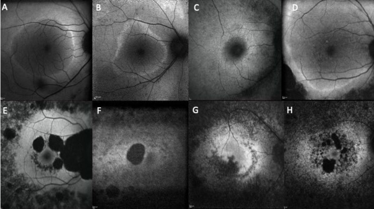 MariyaMoosajee's tweet photo. Well done to Dr Daniel Jackson, my brilliant PhD student @UCLeye @MoorfieldsBRC &amp; @adam_dubis on this great paper providing insights on “The Natural History of #CNGB1-Related Retinopathy: A Longitudinal Phenotypic Analysis.”

https://t.co/GhoeJ0L4JW #mdpiijms via @IJMS_MDPI https://t.co/SS8HPT7mm6