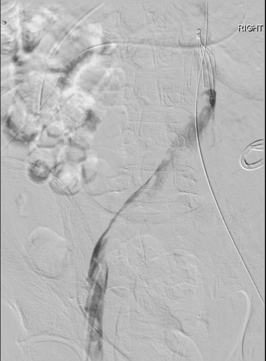 BenTritle's tweet photo. Different kind of #filteroutfriday

Dreaded iliocaval thrombus p IVC filter presenting with phlegmasia, sepsis, Lactate >10.  

Combination lysis, asp/mech thrombectomy &amp; #Abre stent -> Off pressors, out of ICU.

#DVT #Inari #Venous #GTFO #IamIR https://t.co/vk85QACzDg