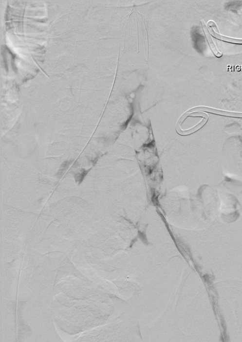 BenTritle's tweet photo. Different kind of #filteroutfriday

Dreaded iliocaval thrombus p IVC filter presenting with phlegmasia, sepsis, Lactate >10.  

Combination lysis, asp/mech thrombectomy &amp; #Abre stent -> Off pressors, out of ICU.

#DVT #Inari #Venous #GTFO #IamIR https://t.co/vk85QACzDg