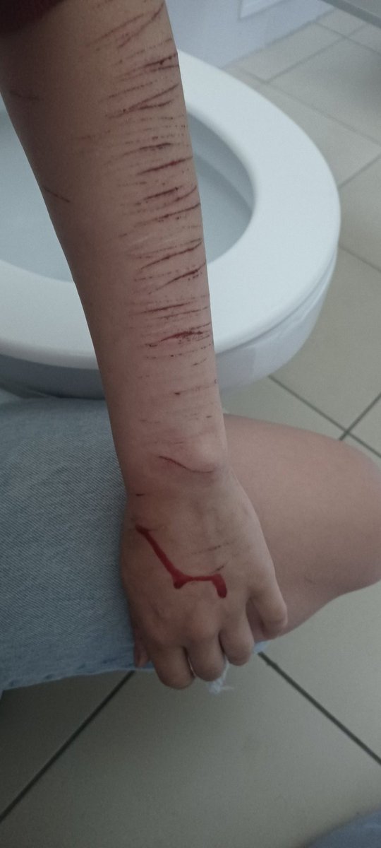 LEE90854662's tweet photo. Tw: self harm, shtwt, styro, styrotwt, cuts, blood
.
.
.
I keep seeing videos of people cutting, and like- why yall swipe so fats???😭😭 bc im just slowly going over the skin, ive never seen any1 else do that
( here are some more old styro cuts lol ) https://t.co/wxIKMwVXLb