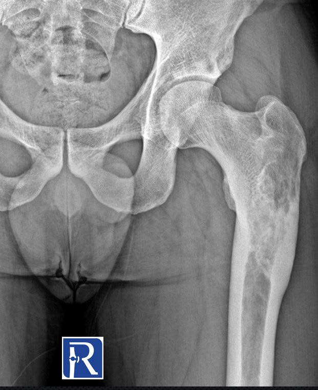 radiologybmj's tweet photo. AP radiograph of left femur shows the mixed lytic and sclerotic one lesion located in proximal metaphysis and diaphysis of left femur. Note the thinning of proximal and thickening of distal cortex. #radiology #MedTwitter #MedTweetMY #radtwitter #orthotwitter #mskrad #radres https://t.co/qWOeTgnxMx