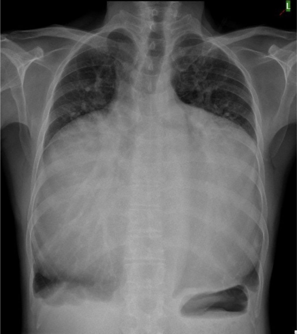 AvrahamCooperMD's tweet image. This is the largest heart I’ve ever seen 🤯

#MedTwitter