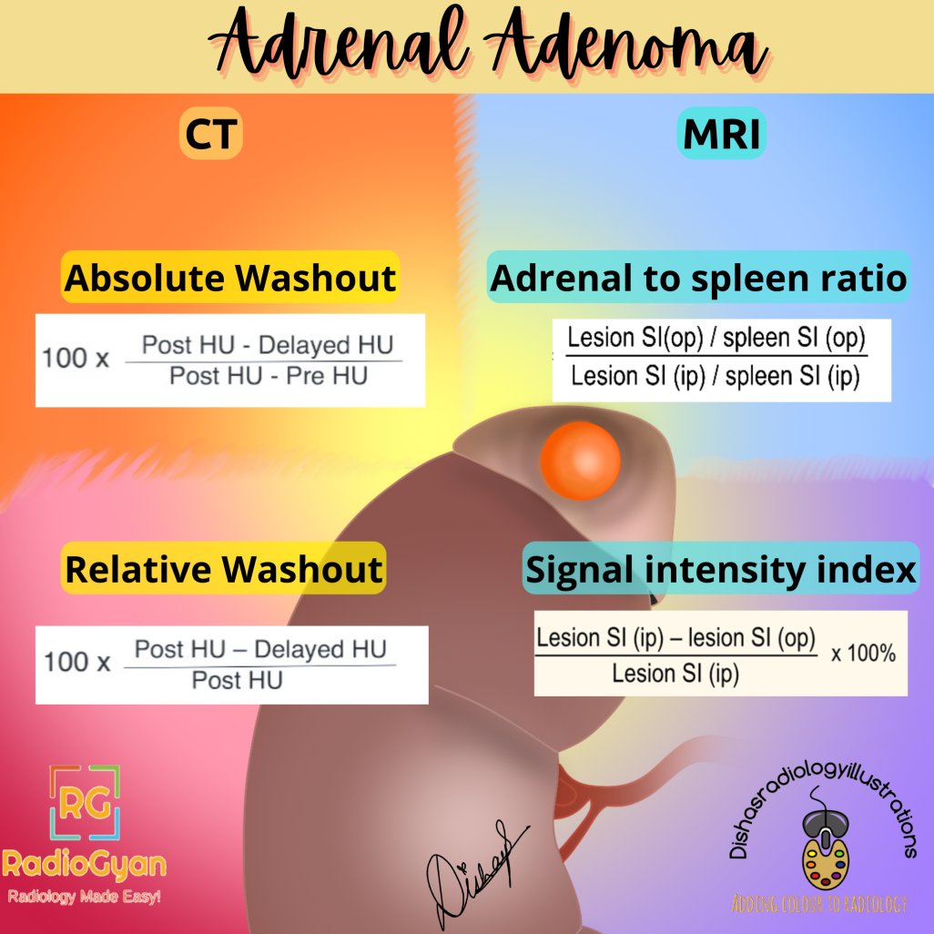 Hey #radres, Check out this adrenal adenoma imaging snippet by TeamGyan member, Dr. Dishal Lokhandwala.  

#FOAMrad #FOAMed #radiology