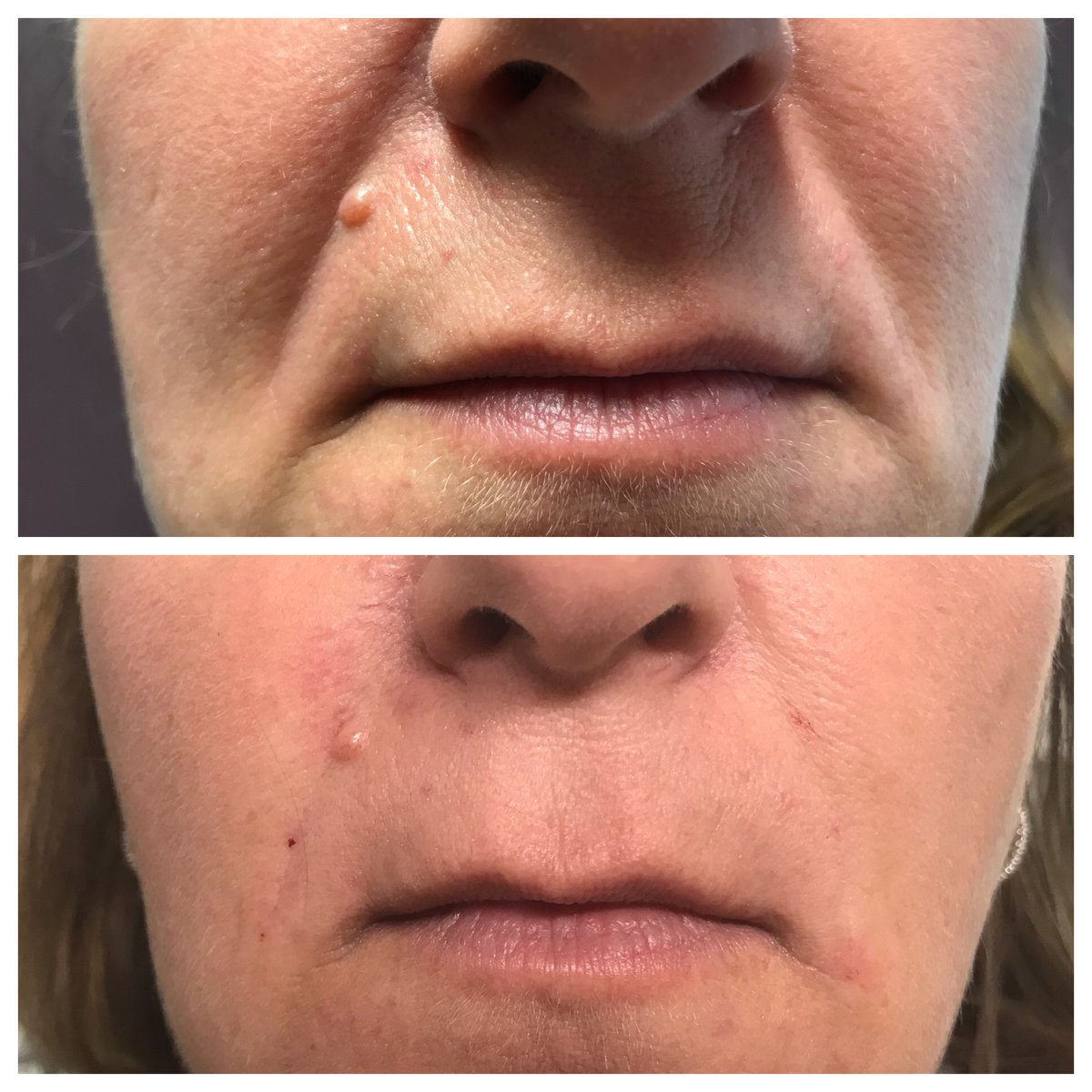 SeiBellaLR's tweet photo. This is just 1 #syringe of #filler. It takes years off her #face and results like this will last 10-14 months depending on which one I use. #Juvederm, #Restylane #Refyne #Defyne #Lyft #Radiesse. #drannetrussell #seibellamedspa 501-228-6237 #antiaging #LittleRock #beauty https://t.co/0cKLA3sYpn