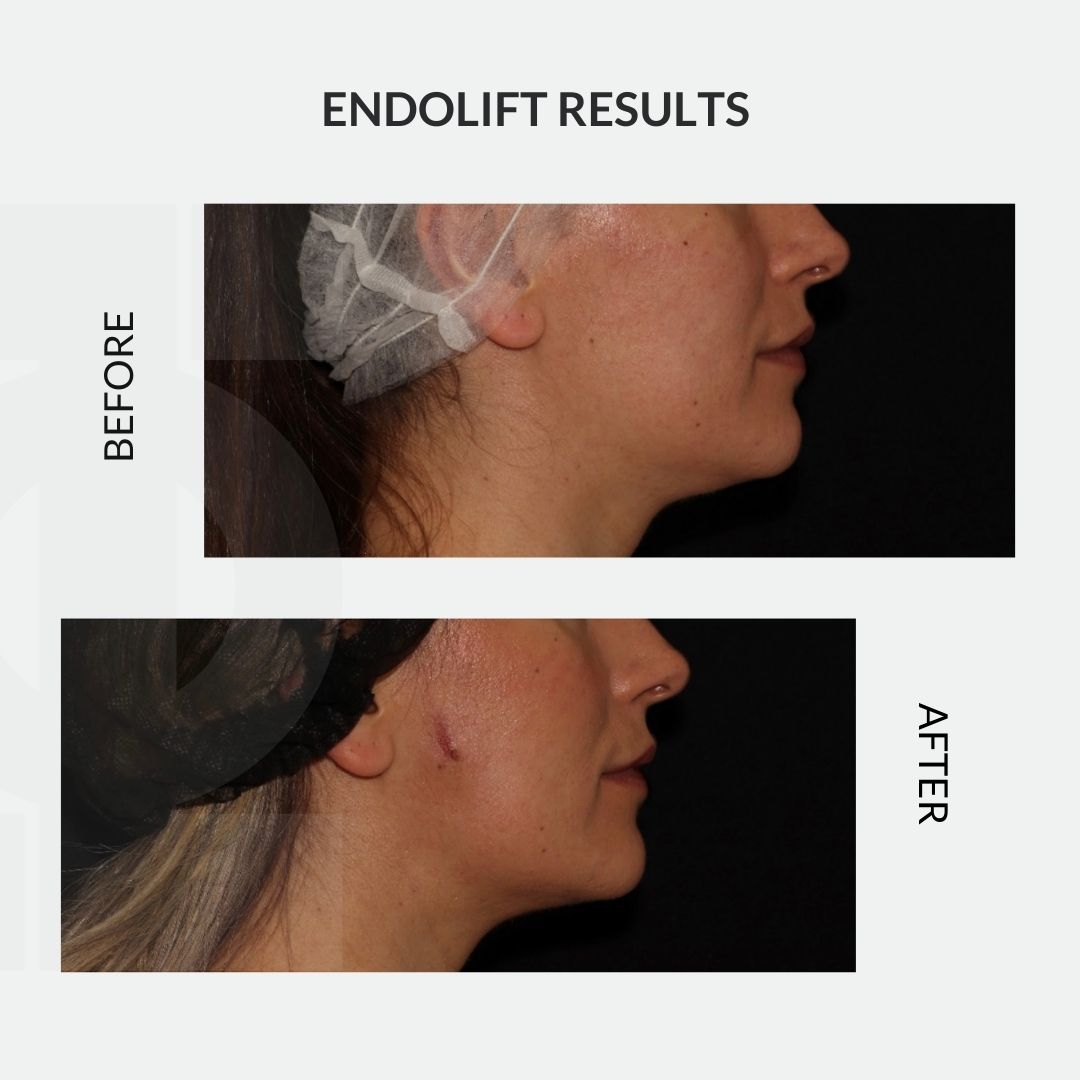 ⁣Give your face a little summer sculpting with Endolift!⁣
⁣
Endolift can be used in combination treatments to achieve dramatic results.⁣⁣
⁣⁣
For further information, DM us or visit our website. ⁣⁣
⁣phiclinic.com/treatment/endo…

#endolift #skintightening
