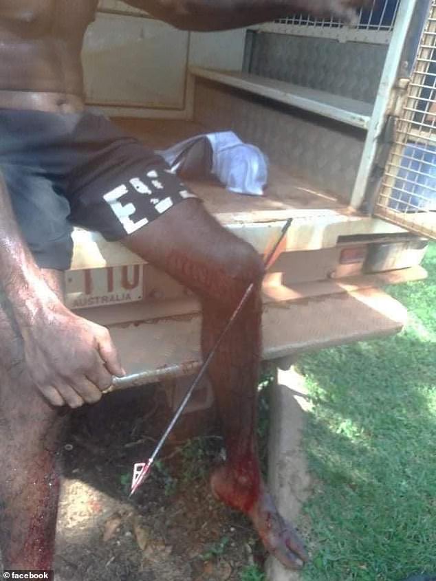 TheNorskaPaul's tweet photo. Pics show men with ARROWS pierced through their arms & legs after 20 crossbows were stolen &used in a fight in #Wadeye #NorthernTerritory #Australia
They were stolen from #MitchellsAdventures #Darwin & remote #Aboriginal community has been marred with violence in recent months. https://t.co/xLOBJvlMSD