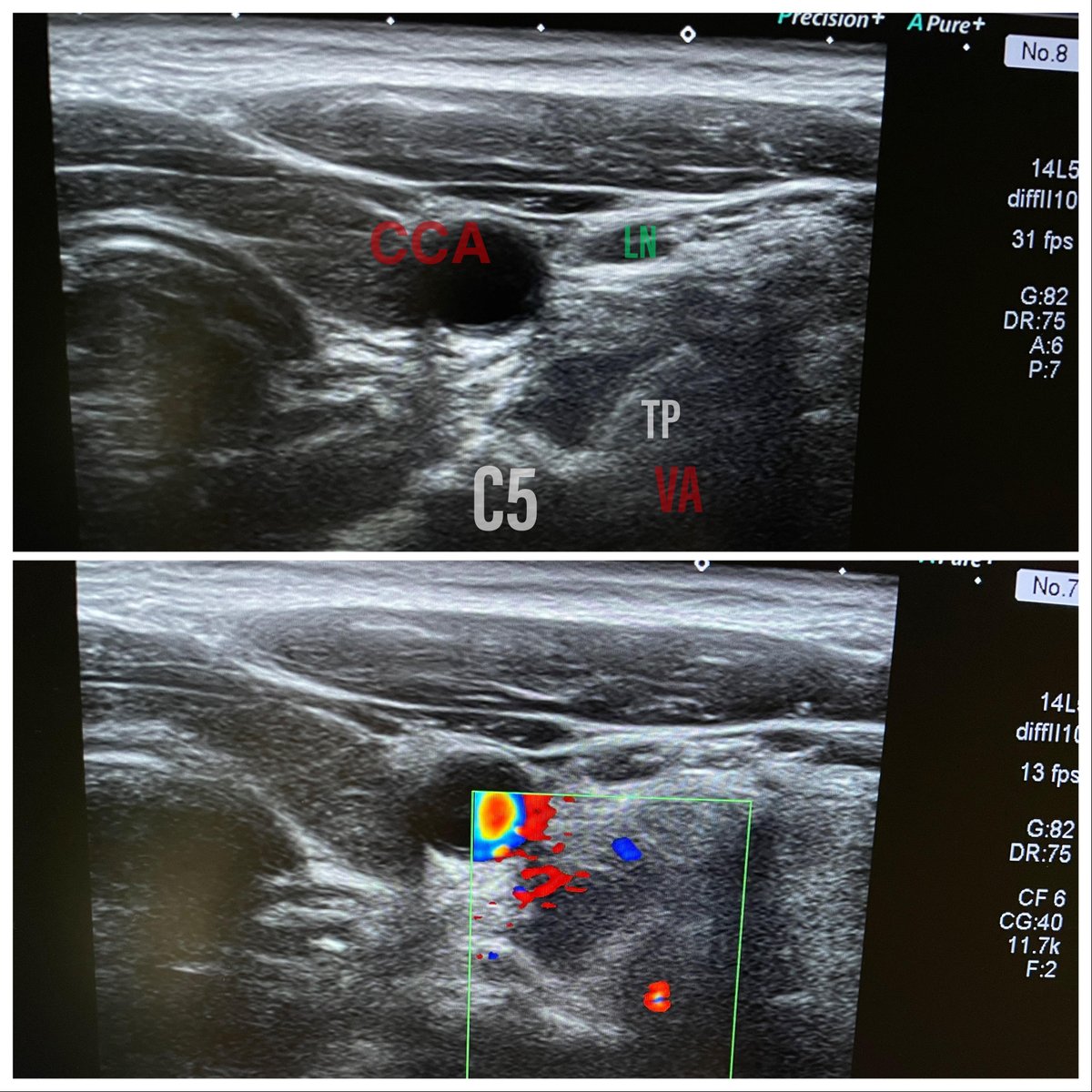 dgleao's tweet photo. Although not a necessity, felt much safer adding US to this lateral approach to cervical #spine Bx.
Pressure on transducer widened space behind vessels compared to CT.
Local injection of iodinated contrast also helped.
Obliviated need for IV contrast
#mskrad #neurorad #radtwitter https://t.co/L3kjUvJHLS