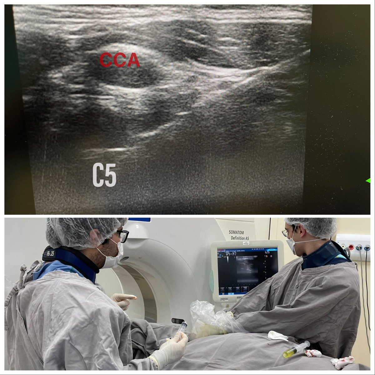 dgleao's tweet photo. Although not a necessity, felt much safer adding US to this lateral approach to cervical #spine Bx.
Pressure on transducer widened space behind vessels compared to CT.
Local injection of iodinated contrast also helped.
Obliviated need for IV contrast
#mskrad #neurorad #radtwitter https://t.co/L3kjUvJHLS