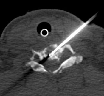 dgleao's tweet photo. Although not a necessity, felt much safer adding US to this lateral approach to cervical #spine Bx.
Pressure on transducer widened space behind vessels compared to CT.
Local injection of iodinated contrast also helped.
Obliviated need for IV contrast
#mskrad #neurorad #radtwitter https://t.co/L3kjUvJHLS