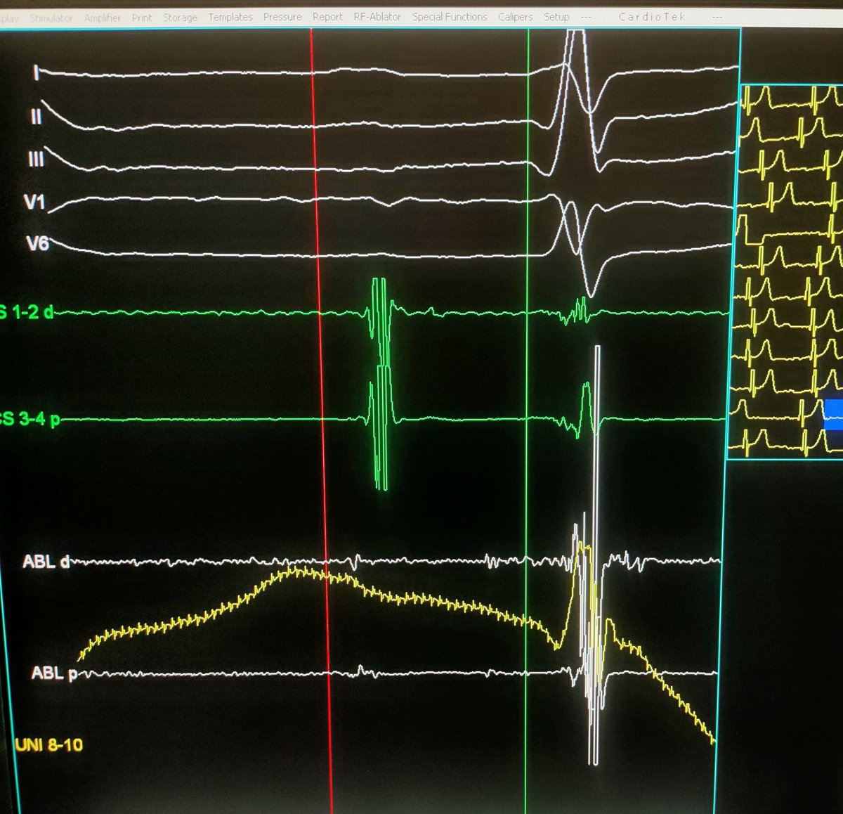 ftrae's tweet photo. CNA case with my friend and mentor Prof. Piotr Kułakowski.

Young male with symptomatic functional I &amp; II grade AV block.

Immediate PR normalization during first RF application near posterior GP

#EPeeps #GPeeps @MDTolgaAksu @PiotrowskiRoman @jczerpa @drrakeshg1 @DhirajGuptaBHRS https://t.co/doZv3vXyjR