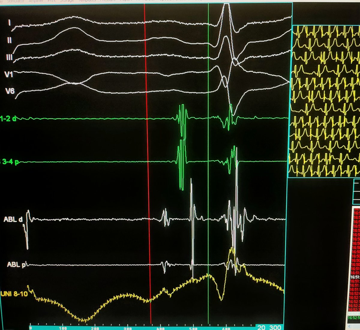 ftrae's tweet photo. CNA case with my friend and mentor Prof. Piotr Kułakowski.

Young male with symptomatic functional I &amp; II grade AV block.

Immediate PR normalization during first RF application near posterior GP

#EPeeps #GPeeps @MDTolgaAksu @PiotrowskiRoman @jczerpa @drrakeshg1 @DhirajGuptaBHRS https://t.co/doZv3vXyjR