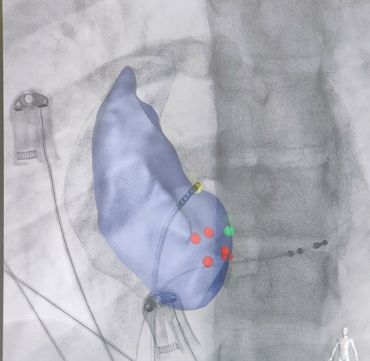 ftrae's tweet photo. CNA case with my friend and mentor Prof. Piotr Kułakowski.

Young male with symptomatic functional I &amp; II grade AV block.

Immediate PR normalization during first RF application near posterior GP

#EPeeps #GPeeps @MDTolgaAksu @PiotrowskiRoman @jczerpa @drrakeshg1 @DhirajGuptaBHRS https://t.co/doZv3vXyjR