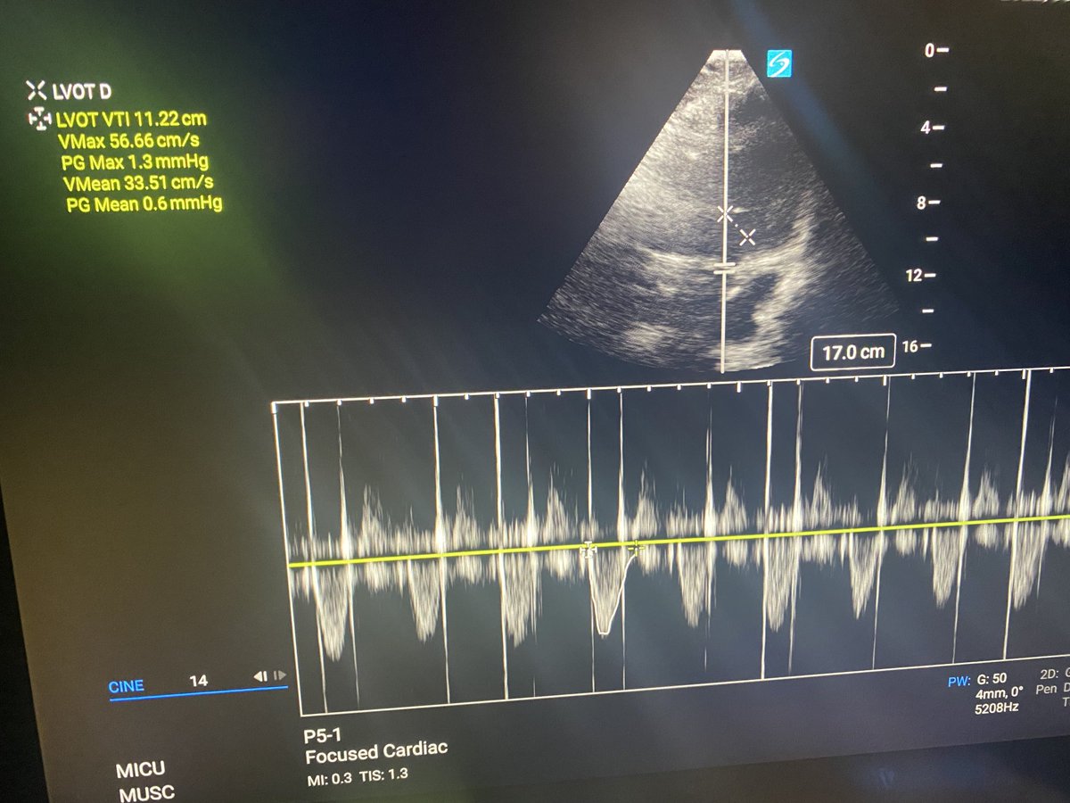 CO/CI estimation w/ VTI has been a great tool to tailor my resuscitation and pressor strategies with mixed clinical pictures too
