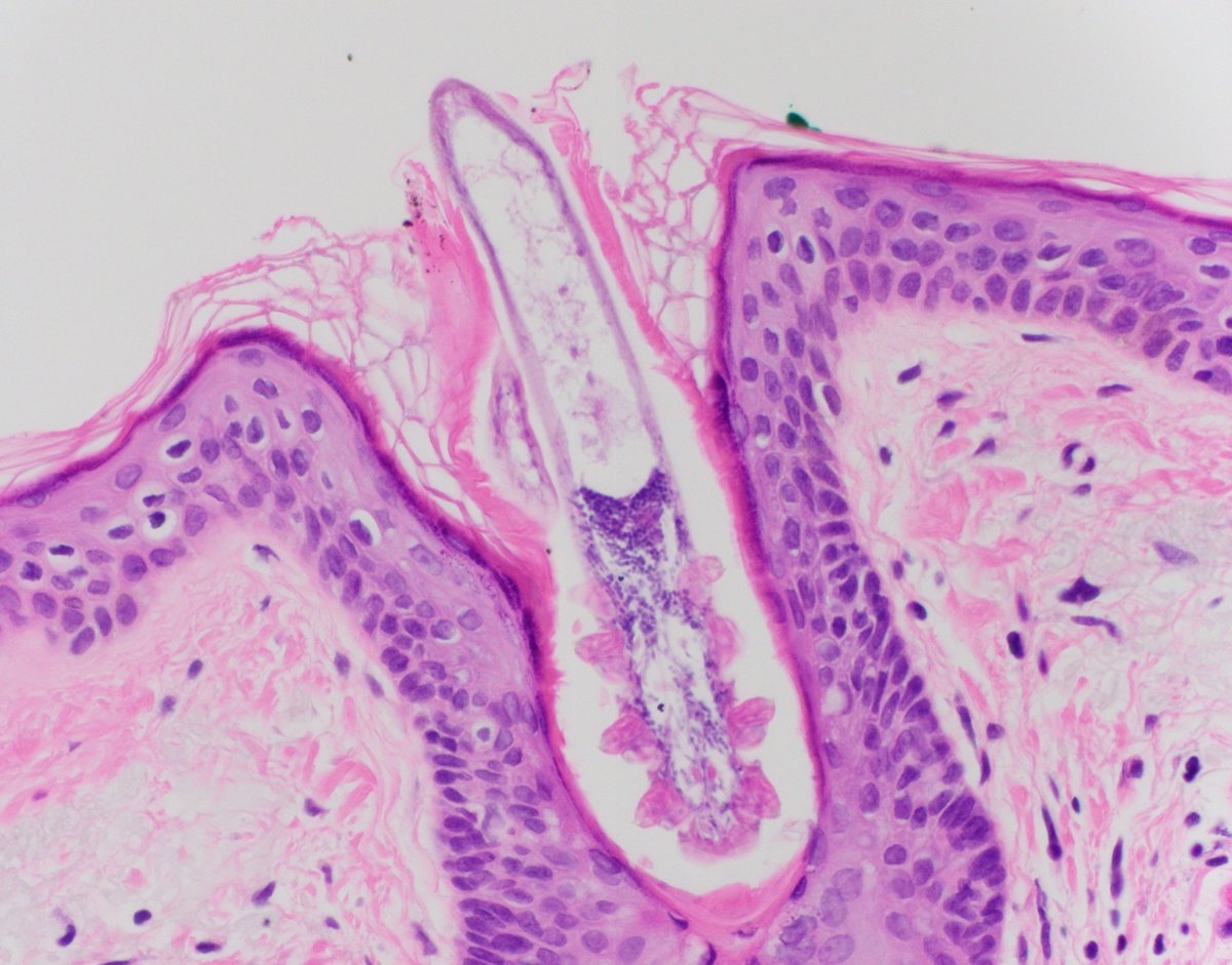 HubertLauMD's tweet photo. Just a couple of exceptionally well-oriented Demodex mites

#DermPath #CrittersOnTwitter https://t.co/IzoBWhks4A