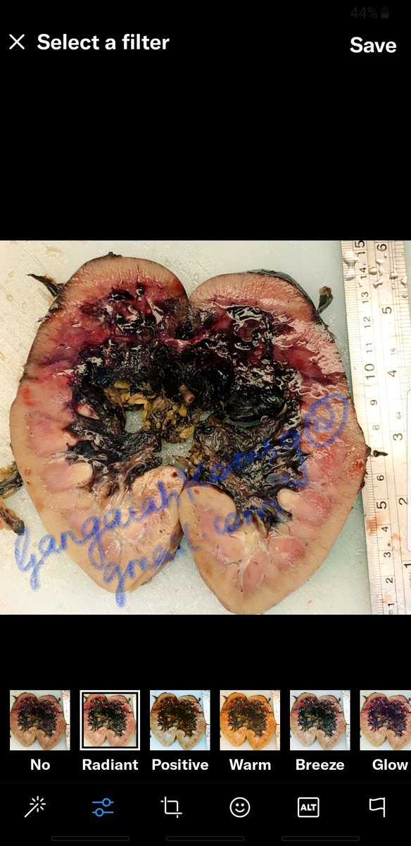 Komalgang's tweet photo. Young patient lost kidney to RTA! This is traumatic kidney injury with 1/3 loss of parenchyma and pelvicalyceal system!#surgicalpath #Urogenitalpath #histopath #clevelandclinic #AIpath @dannydepravity @smlungpathguy @kriyer68 @GreysABC https://t.co/1pRHKHsPbj