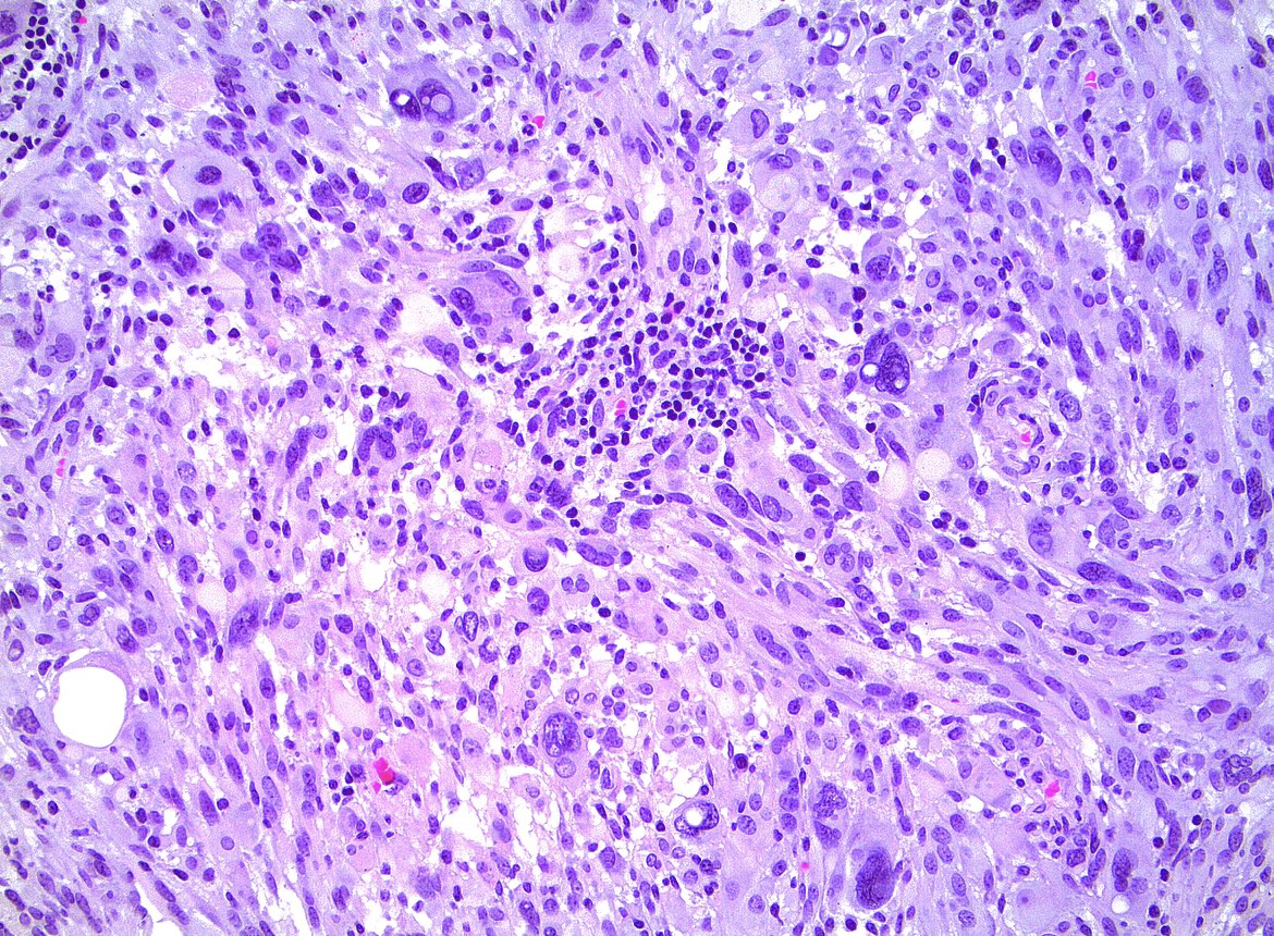 #brain tumor from the temporal lobe of 20s year old. Diagnosis? Most likely genetic alteration? #neuropath 🧠🔬
Pretty eXtreme Atypia, right? 🤓