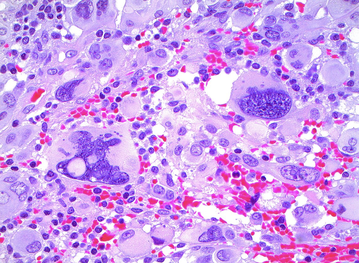 Jared T. Ahrendsen MD, PhD (AP/NP/FP) tweet media