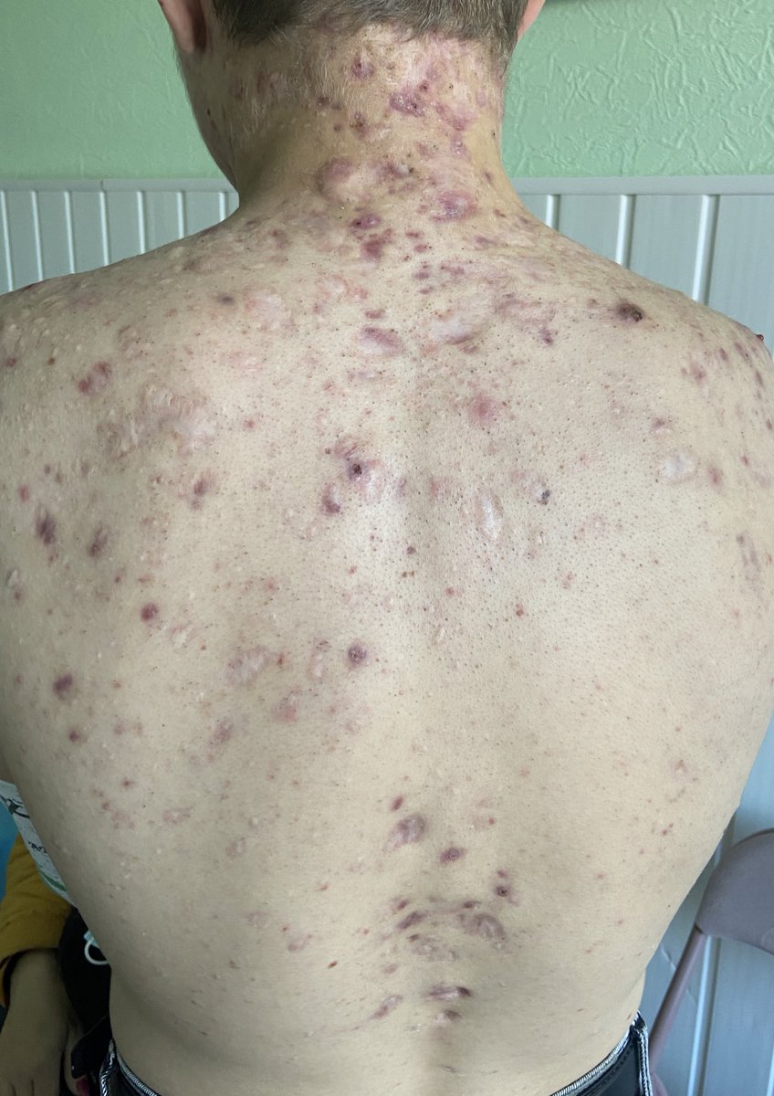 derm_bossy's tweet photo. #acne #dermtwitter #dermcase
Acne conglobata, keloids https://t.co/uFSXliVAKS