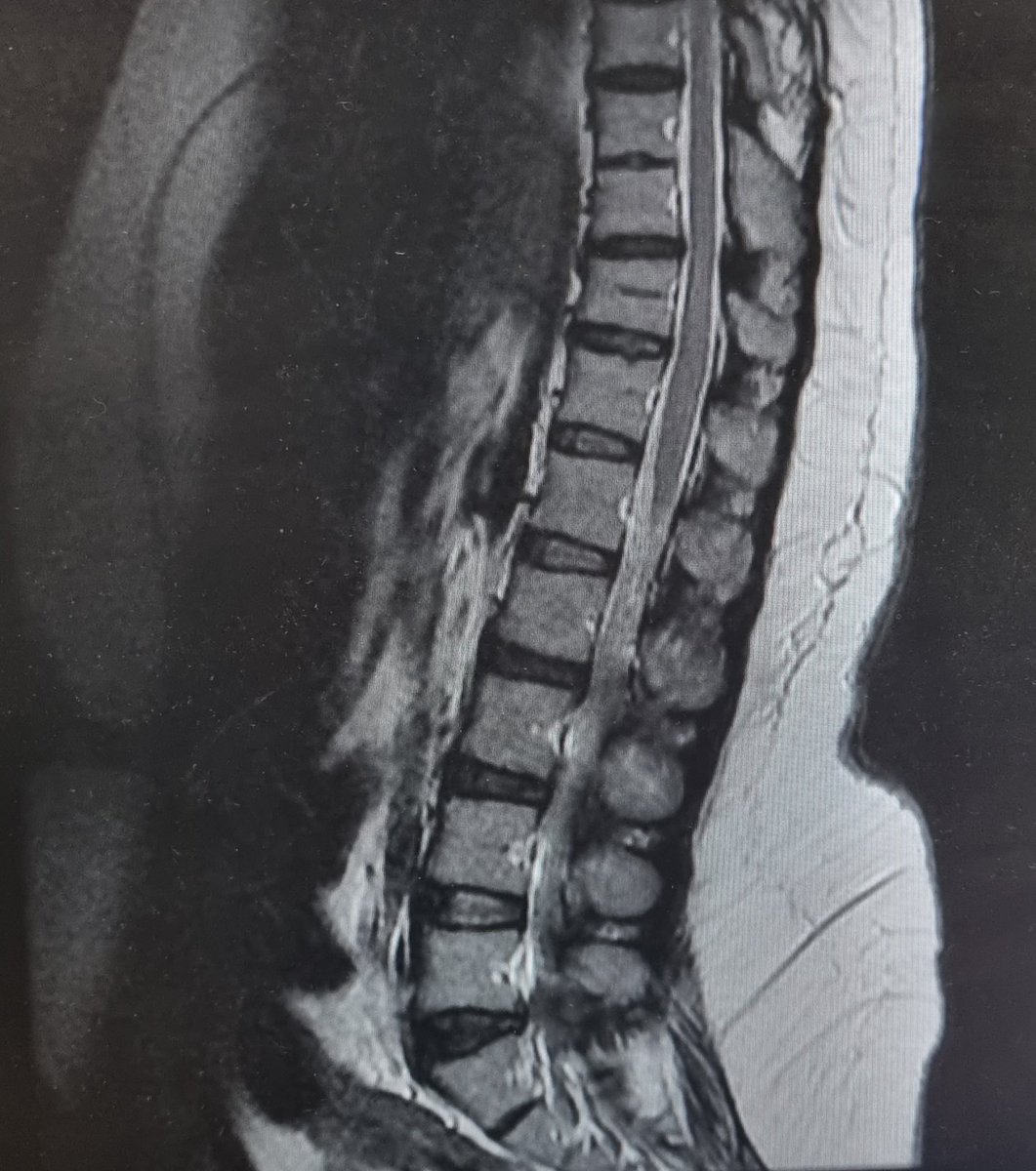 Kevin Tsang (@drtintin99) on Twitter photo #MorningPaper Case 2/ 32F long-term neck and back pain now c/o symptoms of #CaudaEquinaSyndrome for 2 weeks.
What do these scans show?
What's the underlying condition and does it alter your plan?
<a href="/e1v1m1/">BNTA</a> <a href="/BASStrainees/">BASStrainees</a> <a href="/realbrainbook/">Brainbook</a> <a href="/QSReview/">Queen Square Neurosurgery Review Course</a> <a href="/BrainSchool101/">Brain School</a> <a href="/ICNeuroSoc/">IC NeuroSoc</a> #MorningPaper Case 2/ 32F long-term neck and back pain now c/o symptoms of #CaudaEquinaSyndrome for 2 weeks.
What do these scans show?
What's the underlying condition and does it alter your plan?
<a href="/e1v1m1/">BNTA</a> <a href="/BASStrainees/">BASStrainees</a> <a href="/realbrainbook/">Brainbook</a> <a href="/QSReview/">Queen Square Neurosurgery Review Course</a> <a href="/BrainSchool101/">Brain School</a> <a href="/ICNeuroSoc/">IC NeuroSoc</a>