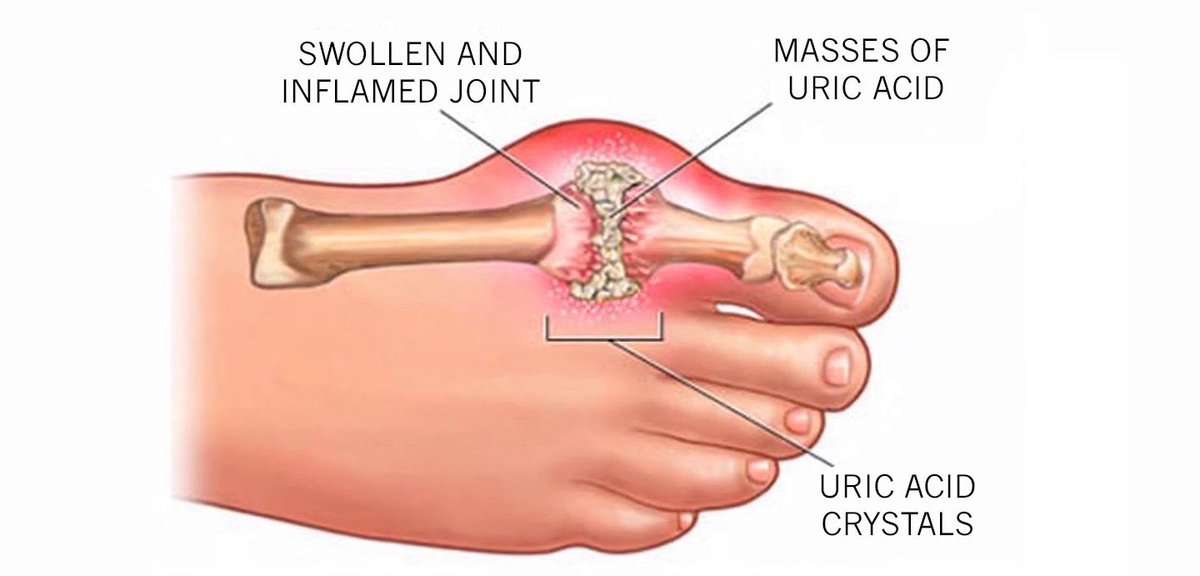 ماهو النقرس ؟ (#Gout)
النقرس هو صورة معقدة من التهاب المفاصل قد تصيب أي شخص ، ويتسم هذا المرض بنوبات...