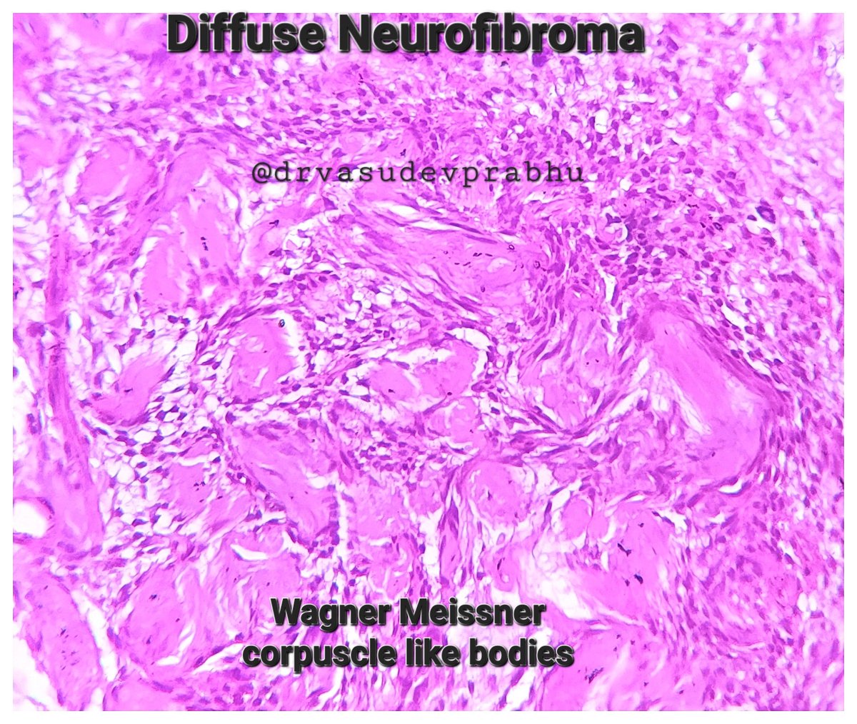 DrVasudevPrabhu's tweet photo. Neurofibroma additional findings.
⭐Micronodules or schwannian cells - microscopic schwannomatosis.
⭐Wagner Meissner corpuscle like bodies  #pathspotters #PathTwitter #PathTwitter #BSTPath #bodiesofpathology @anjuthevirgo @DrApoorvaN1 @RagaviRamanan @RizviUroos @rutuja_narwade5 https://t.co/kJR2W3gIJr