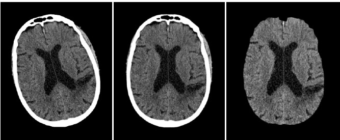 arlindooliveira's tweet photo. Monday, June 27th, Beatriz Vieira will discuss her dissertation entitled "Using a Siamese Network to Accurately Detect Ischemic Stroke in Computed Tomography Scans" in the zoom link https://t.co/UBKyD7Qd1G #MLKD #LUMLIS https://t.co/MPvImXyBrZ