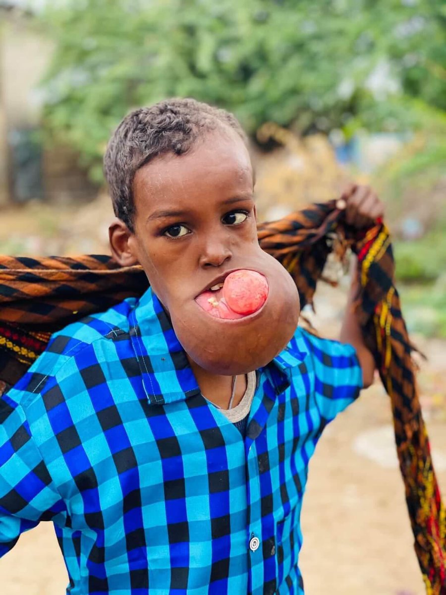 SowdaSudi's tweet photo. This is Salad Mukhtar 12-year-old boy, who lives in Bardheere. The tumor in his tongue has spread to other parts of his mouth. Local doctors recommended treatment abroad after they gave up. He is from a poor family and requires urgent treatment, according to doctors. 25213119552. https://t.co/WqGIM50KjV