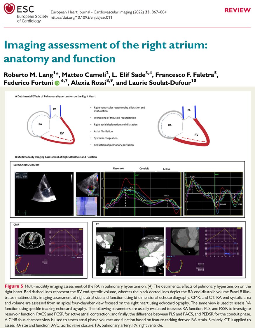 clinicasac's tweet image. 📌REVIEW: AURICULA DERECHA
EVALUACION por IMAGENES📸

🔹Avances cardio intervencionista requieren un conocimiento pleno de anatomía y fisiología de AD
🔸Multi imágenes🎥
🔹Rol de AD en FA y pronóstico en HAP

Seguí 🧵&amp;amp; nstra cta
🆓📂10.1093/ehjci/jeac011
#Cardiotwitter #echofirst