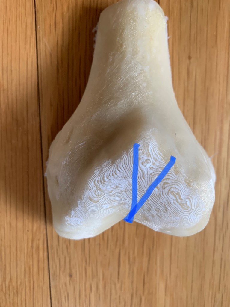 SaveThePatella's tweet photo. #BLOG: Indications change for anteromedialization tibial tubercle osteotomy-- Dr. John P. Fulkerson🔖
https://t.co/pJM7Qp6rmW☑️
#SaveThePatella🦵#GuardiansoftheKnee #PFMasters #PatellofemoralFoundation #PF #LearnFromTheBest @Patelladoc @AJSM_SportsMed @GoHealio @ArthroscopyJ👍 https://t.co/vvZ2iZOaXE