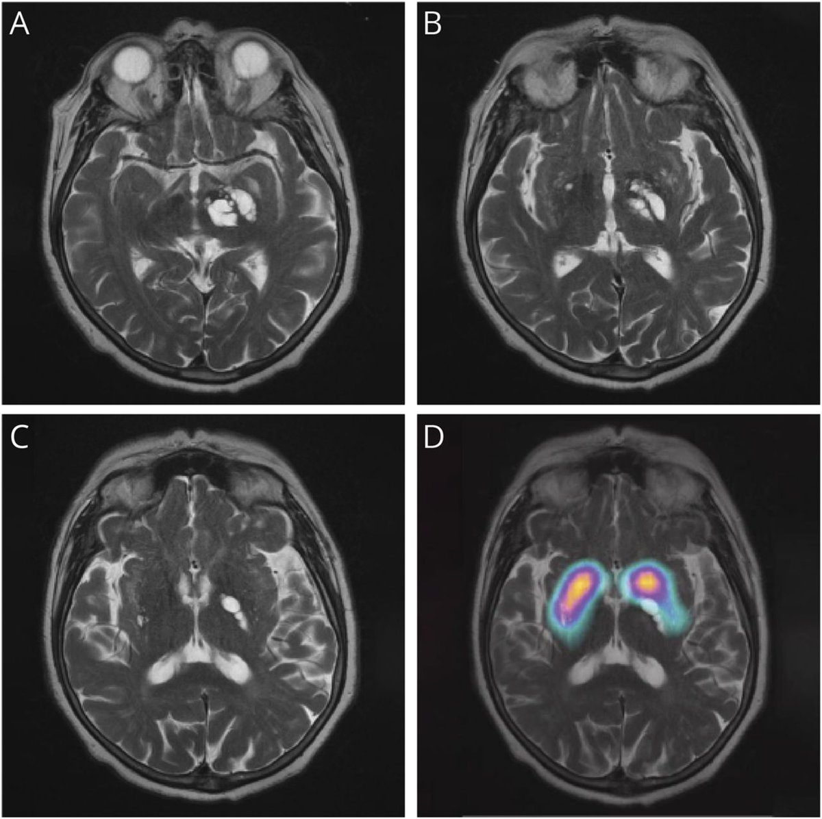 #NeuroImage: Parkinsonism Associated With Striatal Enlarged Perivascular Spaces:
bit.ly/3tYhdi1 #NeuroTwitter #Neurology