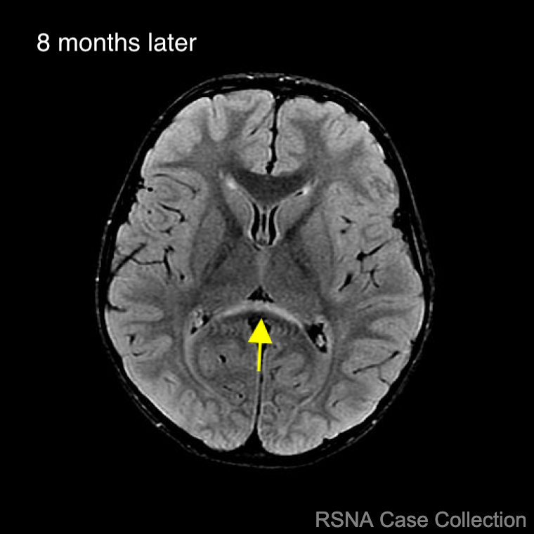 Keep the week going and try this #RSNACC Case-of-the-Week!  What's the diagnosis in this 3-year-old boy with baseline exam? 
Click to answer: 🔗bit.ly/3QNXnQy

<a href="/AANMember/">American Academy of Neurology</a> <a href="/NeurologyCP/">Neurology: Clinical Practice</a> <a href="/PedRadJournal/">Pediatric Radiology</a> <a href="/GreenJournal/">Neurology Journal</a> 
#MedTwitter #NeuroTwitter