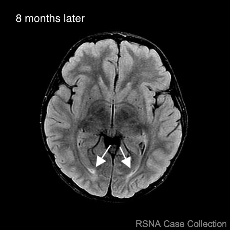 Way to go in diagnosing this great case! 
✅ X-linked Adrenoleukodystrophy
bit.ly/3QNXnQy

Thank you #NeuroRad deputy ed Dr Cynthia Wu <a href="/CynXinWu/">Cynthia Xin Wu</a> &amp; authors Brian Wong, Nga Nguyen, Alvin Camacho, &amp; Woongsoon Choi! <a href="/brianswongmd/">Brian S. Wong, MD MPH</a> @nganguyenmd @utmbradiology 
<a href="/RSNA/">RSNA</a> #RSNACC