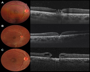 heraldopenacces's tweet image. "Longitudinal evaluation of an acute Nd:YAG laser-induced macular Hole: A case report" 

➡️heraldopenaccess.us/openaccess/lon…

#ophthalmology #fundoscopy #tomography