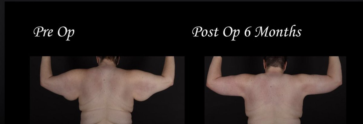 Here is a look at my surgery from pre-op to 6 months. Only posting a back shot. (For those that still ask—I had a bilateral brachioplasty, arm lift and lipo)