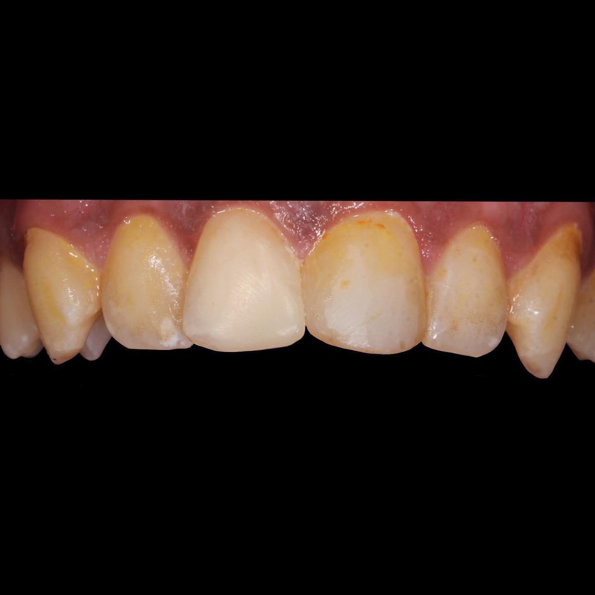 MgDent's tweet photo. حشوة تجميلية للسن الامامي ♥️✨
Anterior Restoration https://t.co/Sb6aLUI3VR