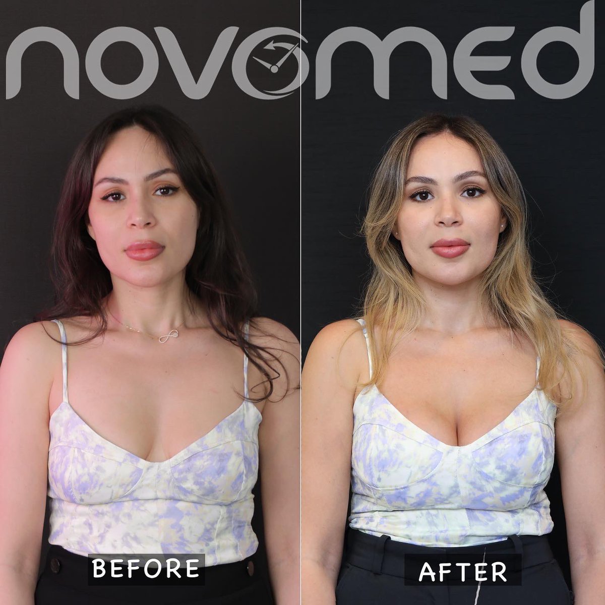 Novomedcenters's tweet image. Are you planning to undergo breast augmentation? Here is what you need to know! 🍒

هل تخططين لإجراء عملية تكبير الثدي؟ إليك ما يجب معرفته 🍒