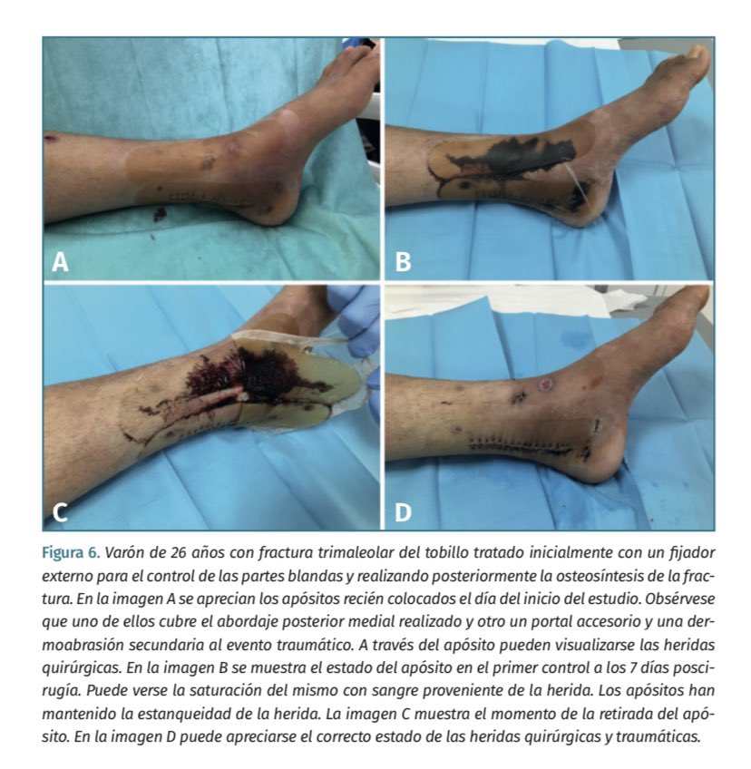 Nuestra última publicación.Apósitos postquirúrgicos miel Manuka.Baja tasa complicaciones,que si existen no aparecen antes de 7 días.¿Porque seguir curando c/24-48h?Curar menos,curar mejor. Texto completo: setla.es/revista-setla/…  <a href="/SETLA11/">SETLA</a> <a href="/Asepeyo/">Asepeyo</a> <a href="/mutuamaz/">Mutua MAZ</a> <a href="/Medihoney/">Medihoney Ltd</a>