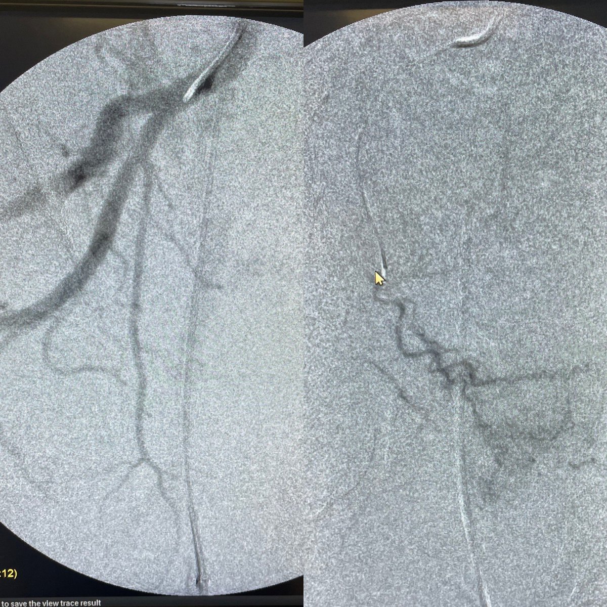 #PAE 2 today: the RARE SG origin to the right PA <a href="/UnitedUrology/">United Urology</a> <a href="/SolarisHealth/">Solaris Health</a> <a href="/UsaProstate/">Prostate Centers USA</a> <a href="/SIRRFS/">SIR RFS</a> <a href="/SIRspecialists/">Society of Interventional Radiology</a> <a href="/StreamMeeting/">STREAMmeeting</a> <a href="/AbinSajanMD/">Abin Sajan</a> <a href="/RPiechowiakDO/">Rachel Piechowiak</a> <a href="/AlexPavidapha/">Alex Pavidapha MD</a> <a href="/riadsalemIR/">Riad Salem</a> <a href="/SamMouli/">Sam Mouli</a> <a href="/IR_Nutt/">Charles Nutting, DO FSIR</a> <a href="/blakepparsons/">Blake Parsons</a>