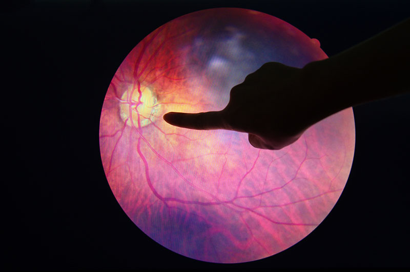 SilversteinEye's tweet photo. Your #vision may be fine, but that doesn't mean you should skip your annual eye exam -- especially if you're at risk for developing #diabetes. Did you know #diabeticretinopathy is one of the leading causes of #blindness in the US? Learn more: https://t.co/bnb7kELdME https://t.co/hvunSurTgR